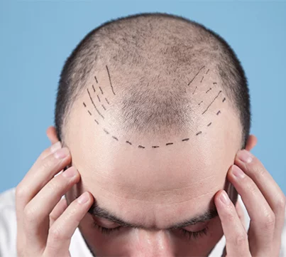HAIR TRANSPLANT